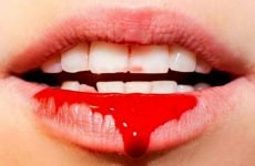 Кров з рота: можливі причини і що при цьому робити