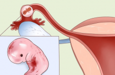 Ознаки і симптоми позаматкової вагітності: як вона проявляється, як зрозуміти за ознаками, бувають кровотечі
