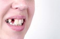 Скільки заживає десна після видалення зуба: як прискорити загоєння рани?