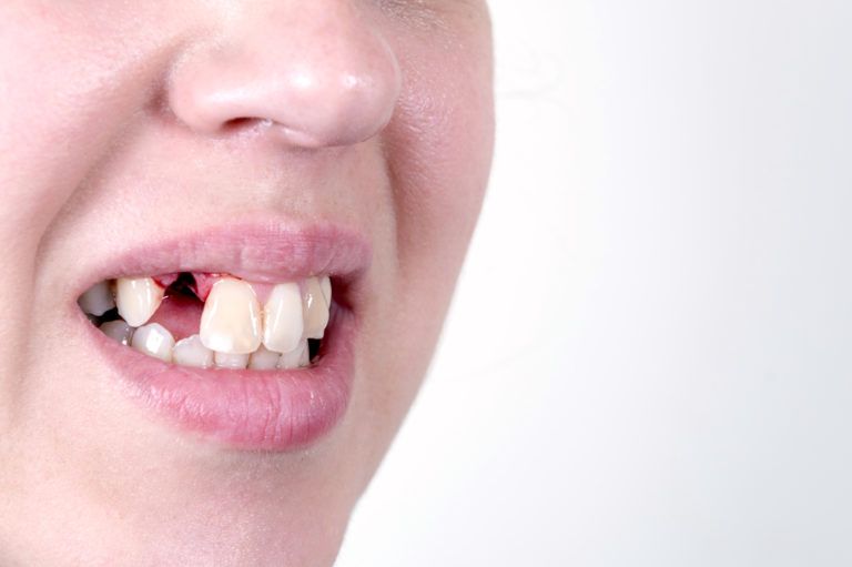 Чим прискорити загоєння ясен після видалення зуба?