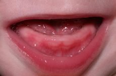 Порядок прорізування корінних зубів у дітей: послідовність зростання