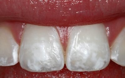 Білі плями на зубах у дитини: причини і методи лікування