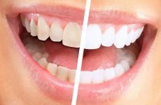 Гель для відбілювання зубів: опис складу, вибір і відгуки