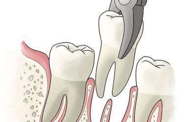 Набряк після видалення зуба: скільки він тримається і як його зняти?