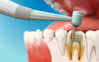 Болить зуб після чищення каналів: причини і методи лікування