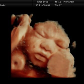 4D УЗД при вагітності (30 фото): що це таке, на якому терміні краще робити «живе» HD УЗД плода, шкода і користь від нього, відгуки