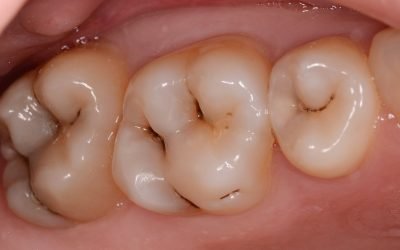 Лікування карієсу: сучасні методики в стоматології