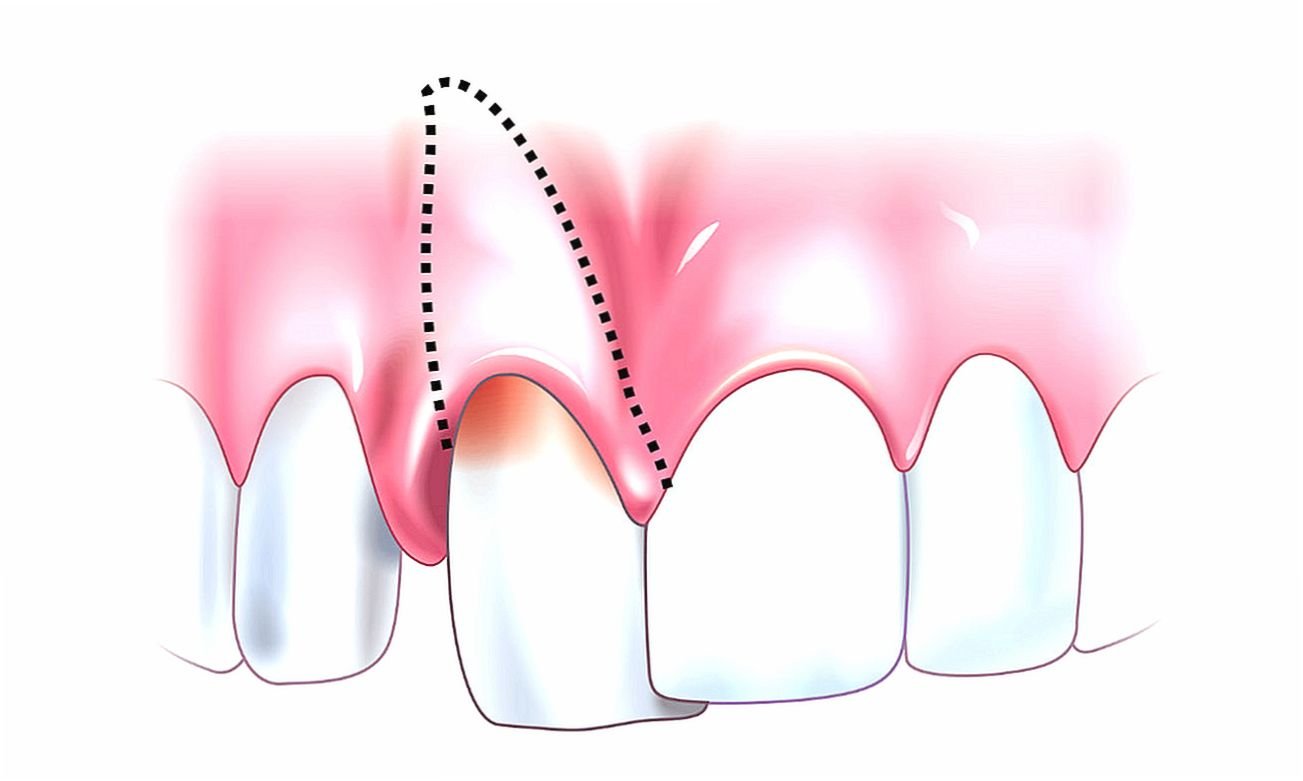 Зубов причины. Периодонтит и воспаление десен. Травматический периодонтит. Вколоченный вывих зуба рентген.
