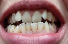 Як вирівняти зуби: причини викривлення і методи виправлення прикусу