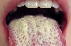 Грибок у роті: причини появи, стадії розвитку та методи лікування