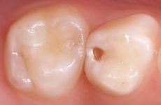 Дірка в зубі: причини виникнення, методи профілактики та лікування