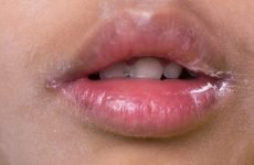 Хвороби губ: причини виникнення, методи лікування та профілактики