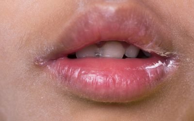 Хвороби губ: причини виникнення, методи лікування та профілактики