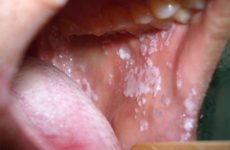 Білий наліт у порожнині рота у дорослих: причини появи й способи лікування