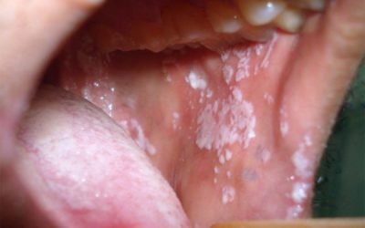 Білий наліт у порожнині рота у дорослих: причини появи й способи лікування