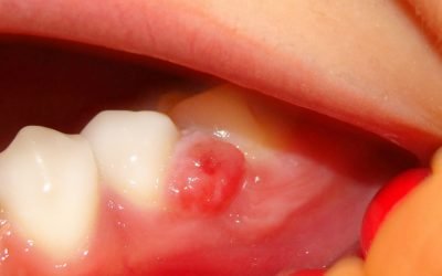 Лікування кісти без видалення зуба: чи можна вилікувати без операції?