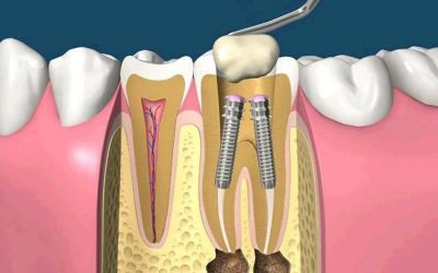 Після установки штифта болить зуб: причини і методи лікування