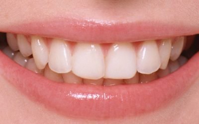 Пломбування зубів: різновиди пломб та особливості установки