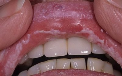 Білий наліт на губах у дорослих: причини виникнення та методи лікування