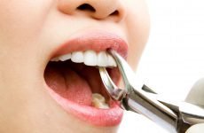 Таблетки після видалення зуба: список препаратів