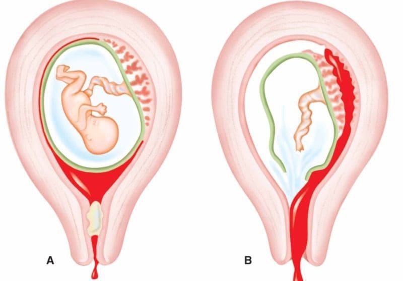 Вакуум аспірація порожнини матки при завмерлої вагітності: як проходить, які наслідки, виділення, відновлення і вагітність після процедури