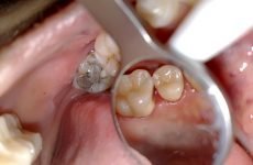 Запалення зубного нерва: причини і методи ефективного лікування