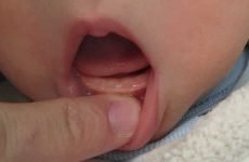 Можуть різатися зуби в 2 місяці: симптоми та допомога немовляті