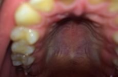 Чому болить небо у роті: причини, методи лікування та профілактики