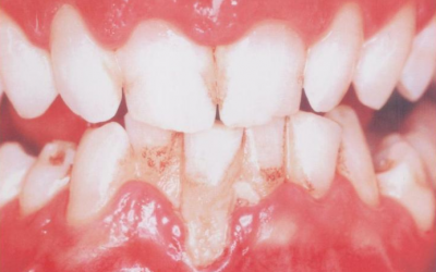 Аномалії розвитку зубів: причини порушень, симптоми та діагностика