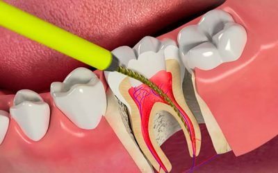 Чому болить мертвий зуб: причини і методи вирішення проблеми