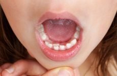 У дитини ростуть зуби другим рядом: причини і методи корекції