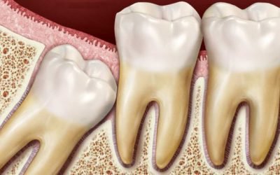Що робити, якщо зуб мудрості росте в зуб: видалення лежачого зуба