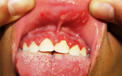 Виразки у роті (афтозний стоматит): причини, лікування, до якого лікаря звернутися