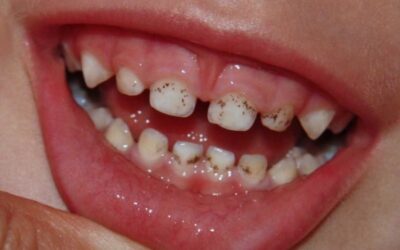 Чорний наліт на зубах у дітей: причини появи та методи лікування