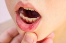 Стоматит мовою у дитини: прості способи лікування