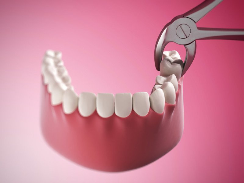 Як зупинити кров після видалення зуба: ефективні способи