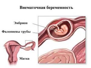 Позаматкова вагітність на якому терміні лопається труба: симптоми і наслідки
