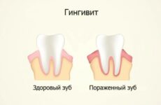 Опухла десна біля зуба – способи правильного лікування