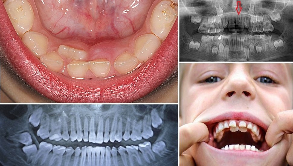 Сверхкомплектные зуби або гіпердонтія   причини виникнення і лікування