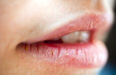 Як лікувати хейліт на губах: причини розвитку захворювання та його ознаки