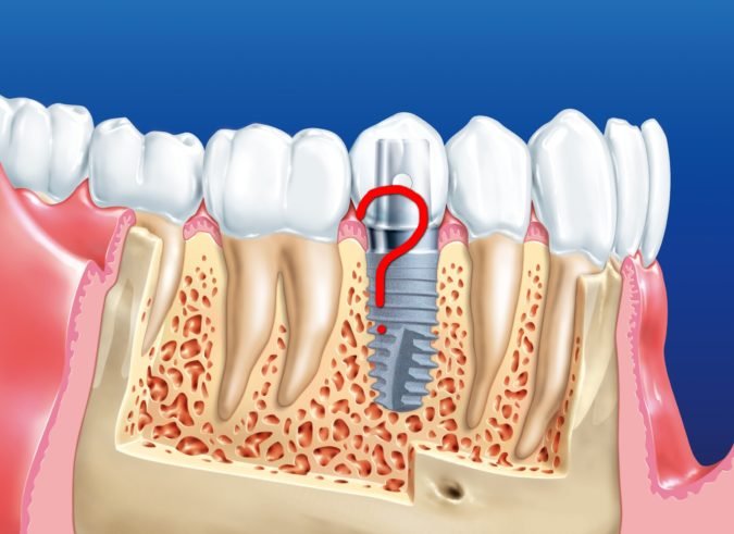 Рекомендації після імплантації зубів верхньої і нижньої щелепи