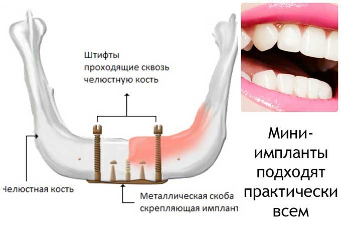 Альтернатива імплантації зубів в майбутньому