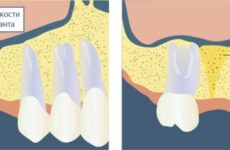 Нарощування кісткової тканини для імплантації зубів – технологія, ціна операції