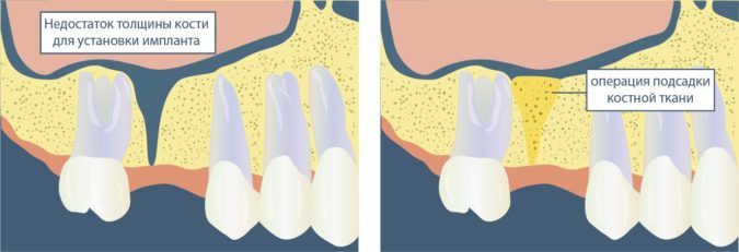 Narashhivanie kostnoj tkani dlya implantatsii e1513861205865.jpg
