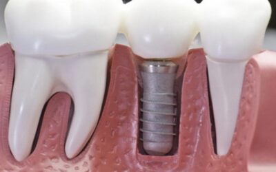Нарощування зуба на штифт: опис процедури