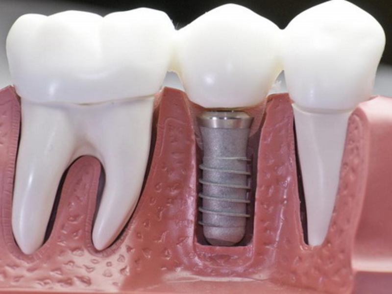 Нарощування зубів: що це таке і як відбувається нарощування