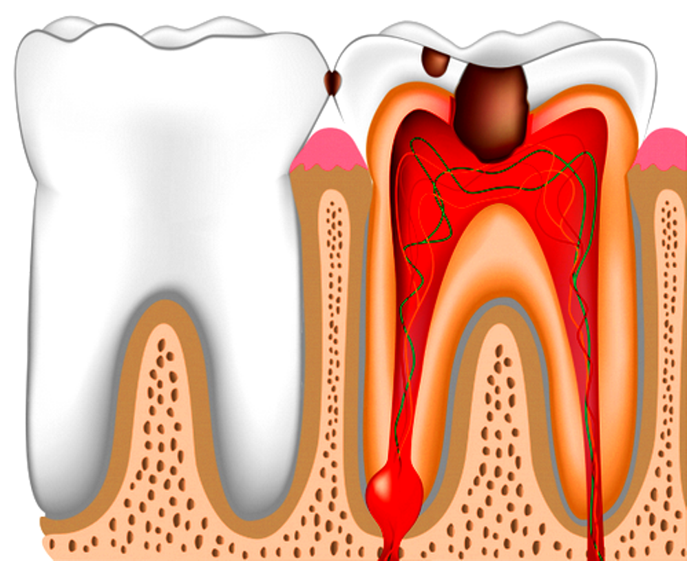 Оголений зубний нерв: методи усунення болю в домашніх умовах