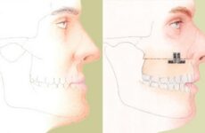 Остеотомія нижньої щелепи: особливості проведення операції