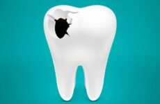 Що таке перфорація зуба: симптоми і лікування