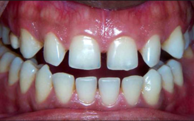 Рідкі зуби: небезпека такої аномалії і методи її лікування